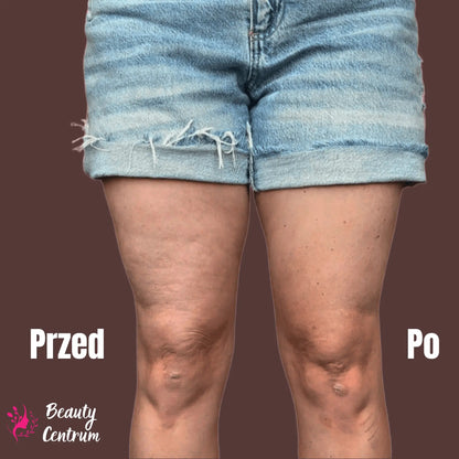 Plastry antycellulitowe - Cellumove